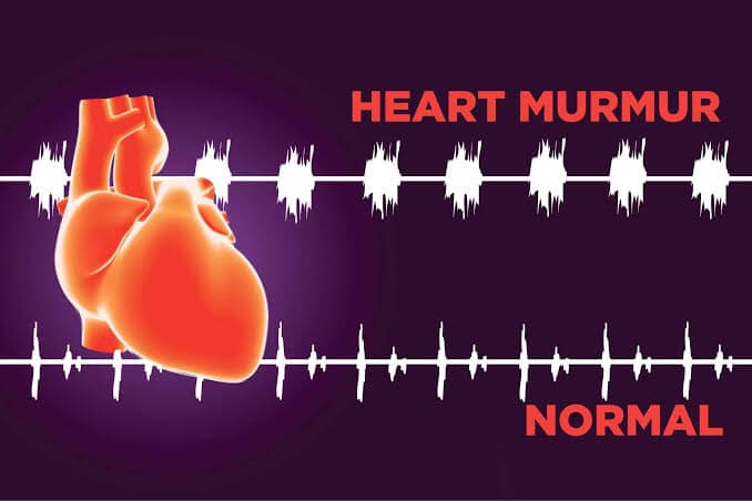 What can cause heart murmurs?